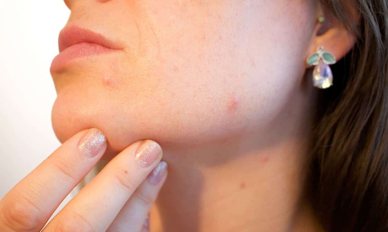 Blackheads have a way of being a nuisance. Here are some tips to help manage them.